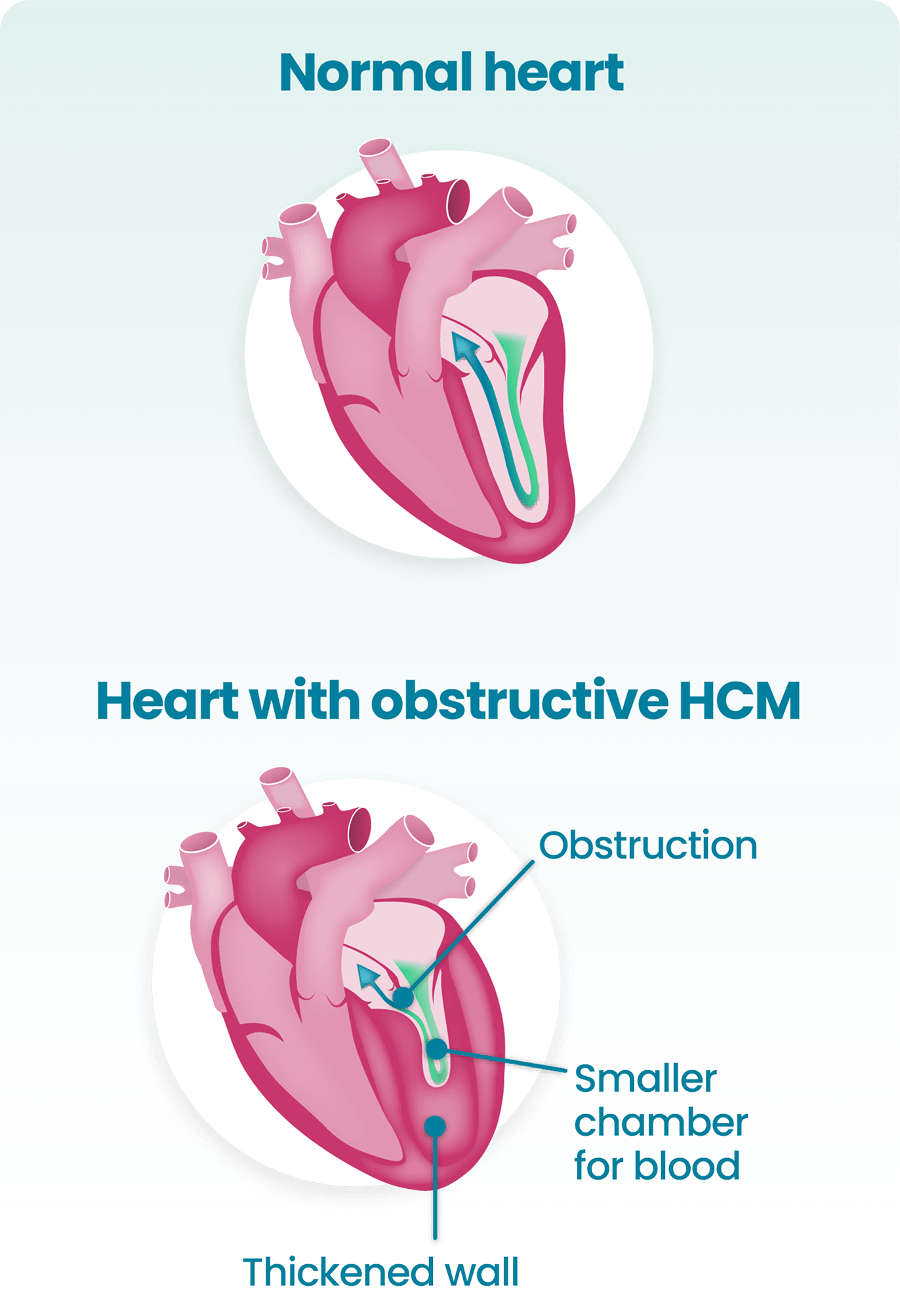 Normal heart versus heart with obstructive HCM